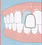 veneers.jpg (28368 bytes)