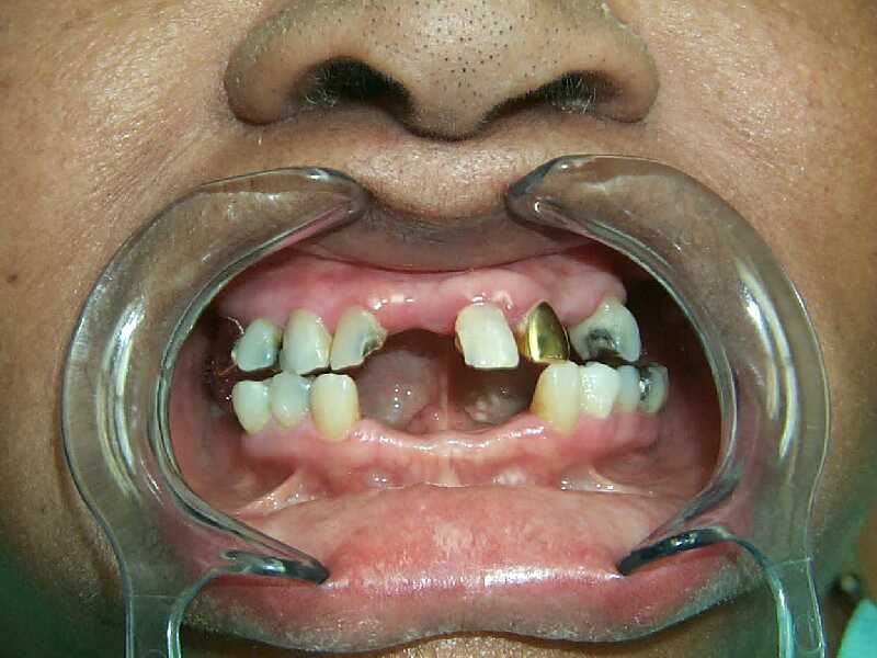 gapped tooth tooth gap invisalign